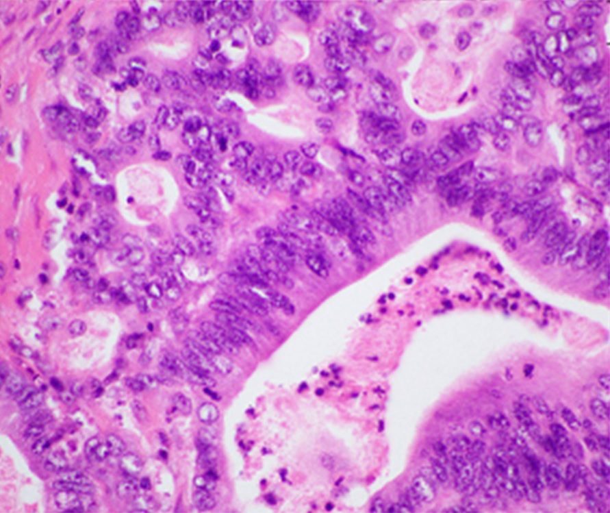 Imagem histológica de adenocarcinoma ductal pancreático em tons rosa e violeta